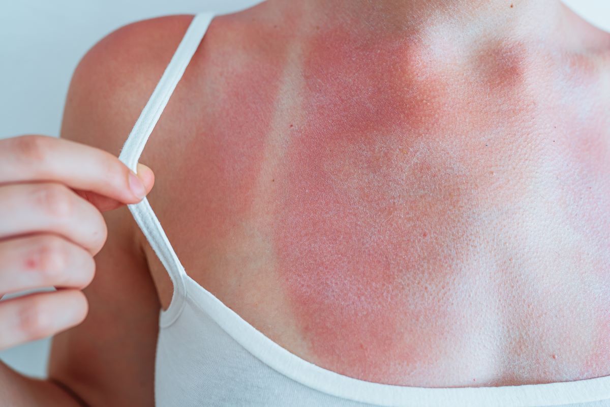 Sonnenbrand in Mettmann: Vermeiden, richtig behandeln und er